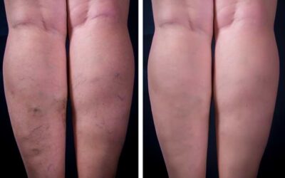 Varicose Veins: An Overview