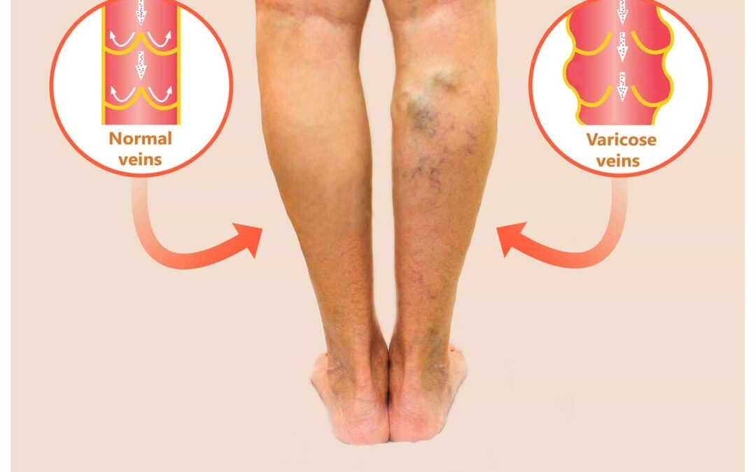 What Is Endovenous Thermal Ablation?