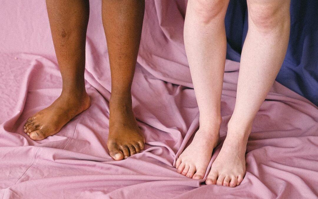 Can Spider Veins Go Away With Weight Loss?